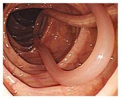 pasożyty w organizmie człowieka
