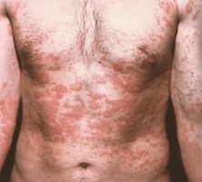 problematyczna skóra jest objawem obecności pasożytów