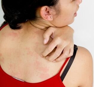 ziarniniaki na ciele - objawy obecności pasożytów