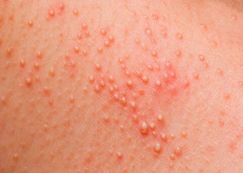 Jeśli organizm jest zaatakowany przez pasożyty, pojawia się alergia skórna